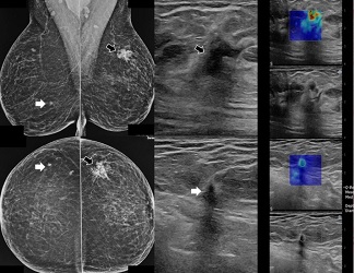 Synchronous Bilateral Breast Carcinoma Treated with Breast Conserving Surgery. Presentation of Two C...